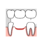 Dental Bridge