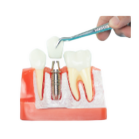 Tooth Replacement