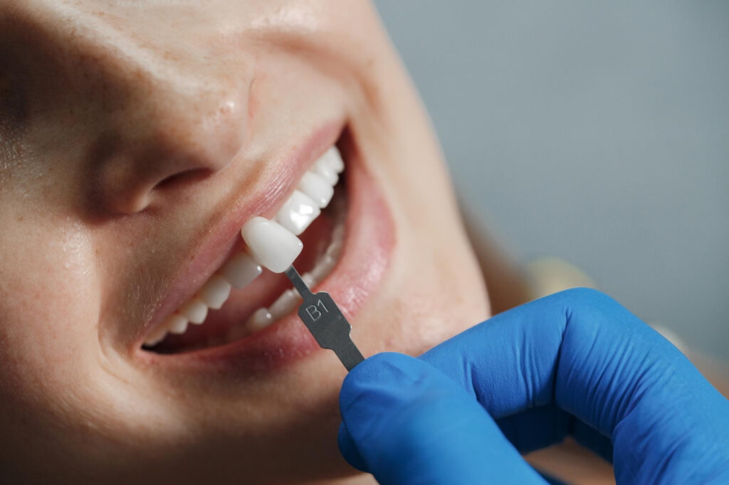 Dazzle with a Metal-Free Smile – Choosing the Perfect Veneers or Crowns Material at Alpine Dental