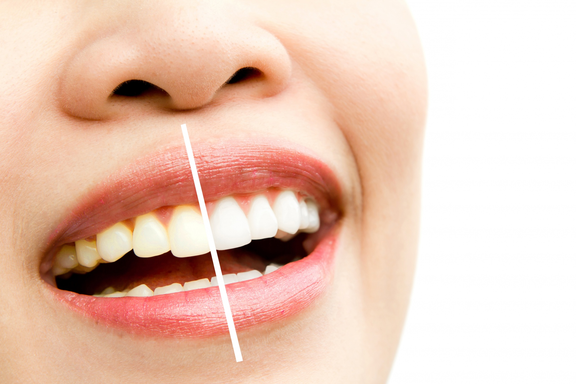 A young woman's set of teeth compared with a line that shows yellow and then perfectly white teeth
