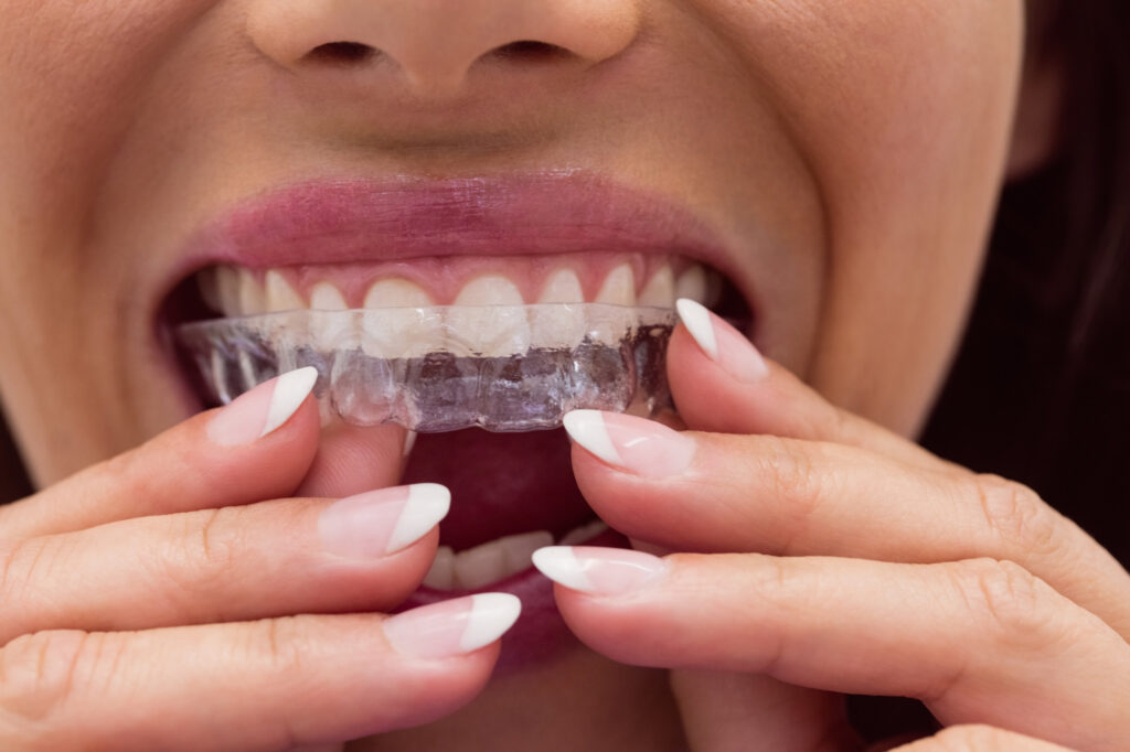 Clear Aligners for All Ages & An In-Depth Look at Invisalign Treatment Options