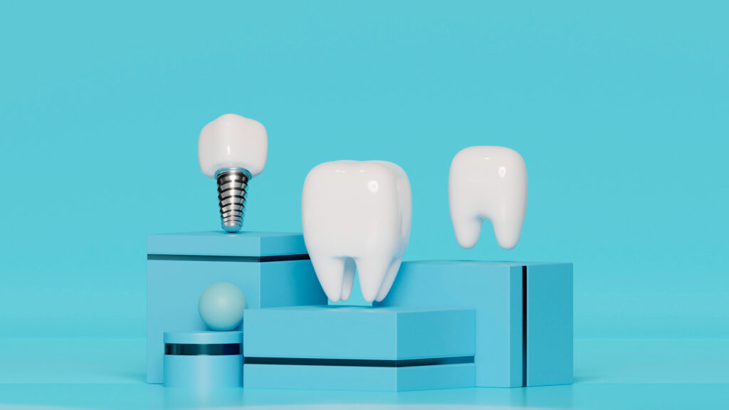 Top Three Questions About Dental Implants Answered!