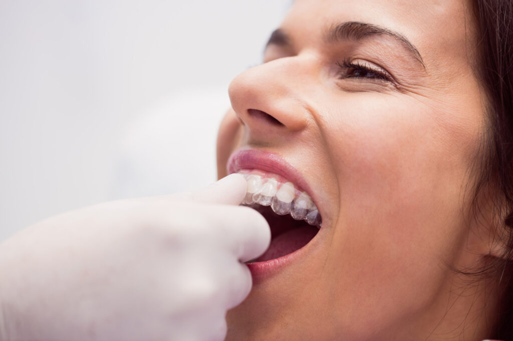 Invisalign vs Braces: A Comparison of Clear Aligners to Traditional Orthodontics