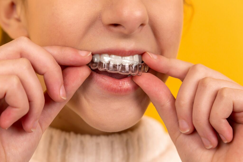 What to Expect with Invisalign Treatment Costs