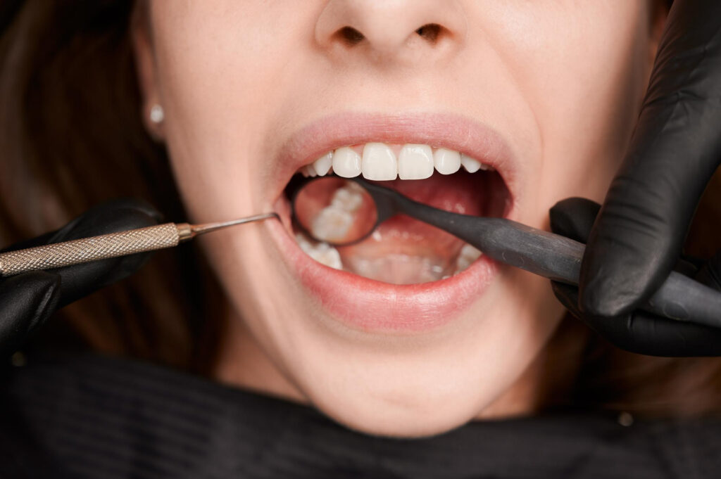 Dental Sealants & The Simple Way to Prevent Cavities in Young Back Teeth